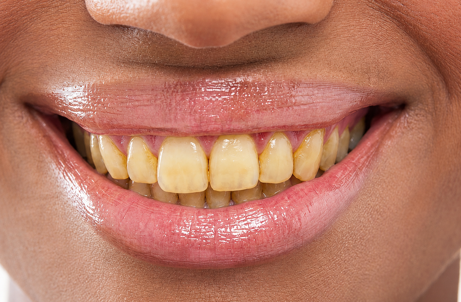 Sorriso antes do tratamento - Caso 1